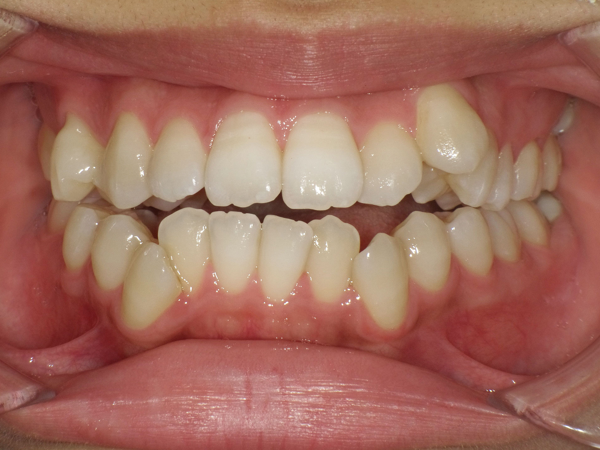 開咬（オープンバイト）を裏側矯正で改善した症例（横浜市・20代女性）｜横浜まつざわ矯正歯科