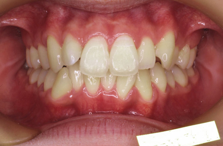 ガタガタを裏側矯正（リンガル矯正）で改善した症例（横浜市・20代女性）｜横浜まつざわ矯正歯科