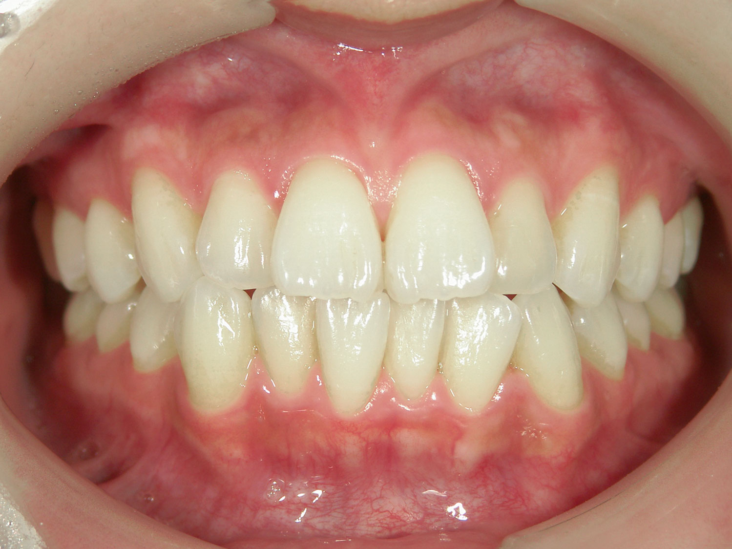 ガタガタをマウスピース矯正（インビザライン）で改善した症例（横浜市・20代女性）｜横浜まつざわ矯正歯科