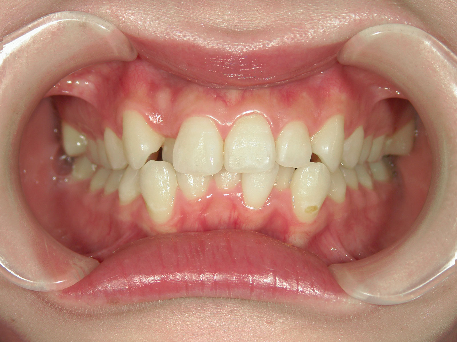 ガタガタをマウスピース矯正で改善した症例（横浜市・20代女性）｜横浜まつざわ矯正歯科