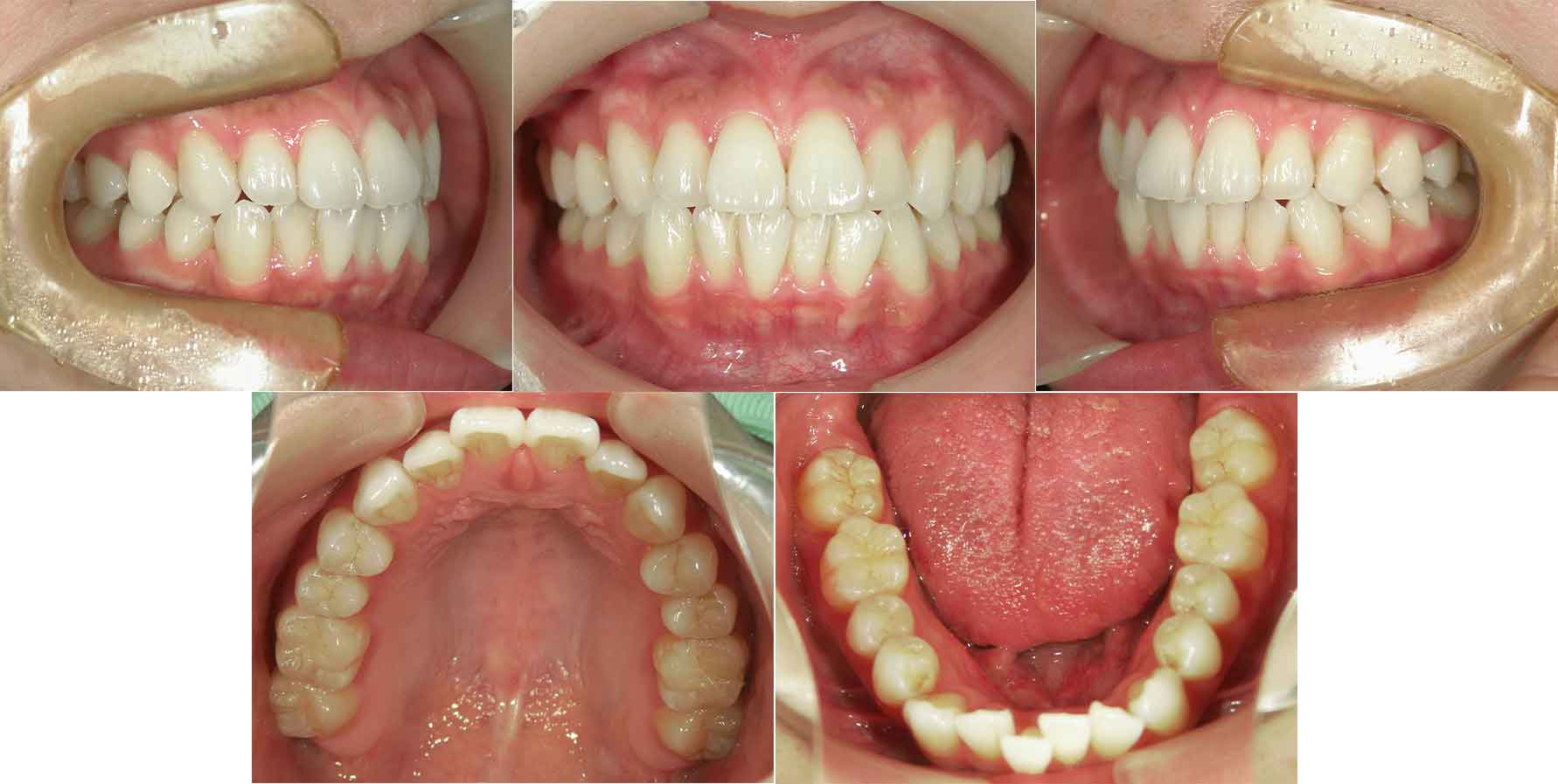 横浜市・20代女性の矯正治療前