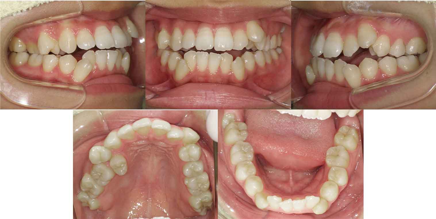 治療前の歯並び（叢生と開咬・横浜市の20代女性）