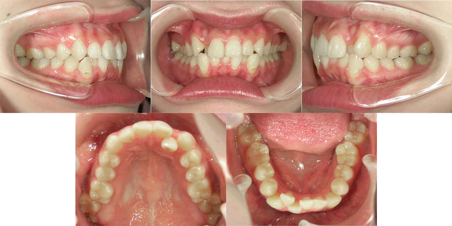 横浜市・20代女性の矯正治療前