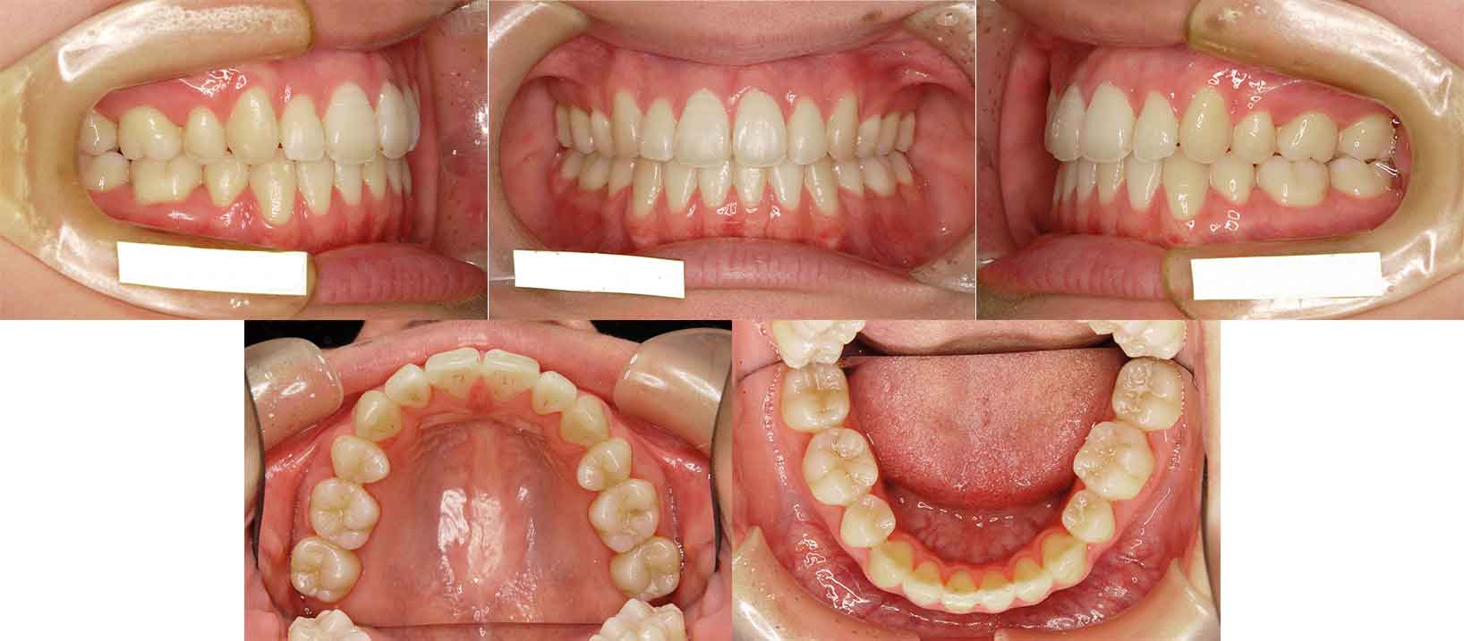 上顎前歯に強い重なりが見られ、下顎も前歯が内側に倒れ込んでいる状態でした。