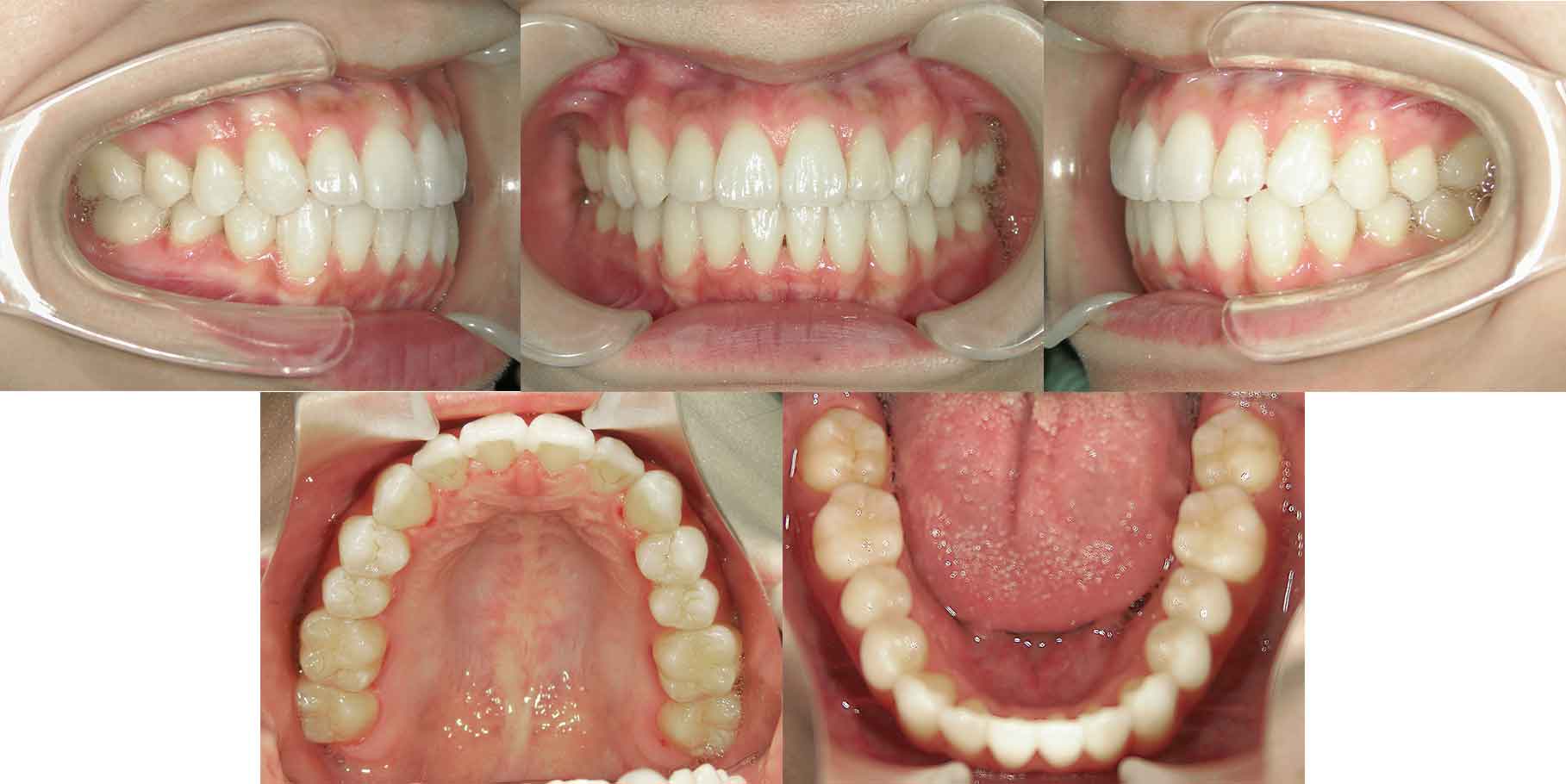 治療後の歯並び（叢生・横浜市の20代女性）