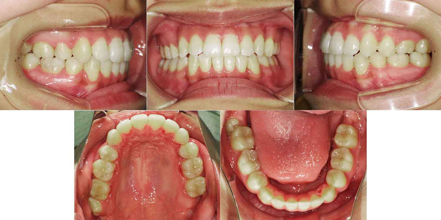 治療後の歯並び（叢生と開咬・横浜市の20代女性）
