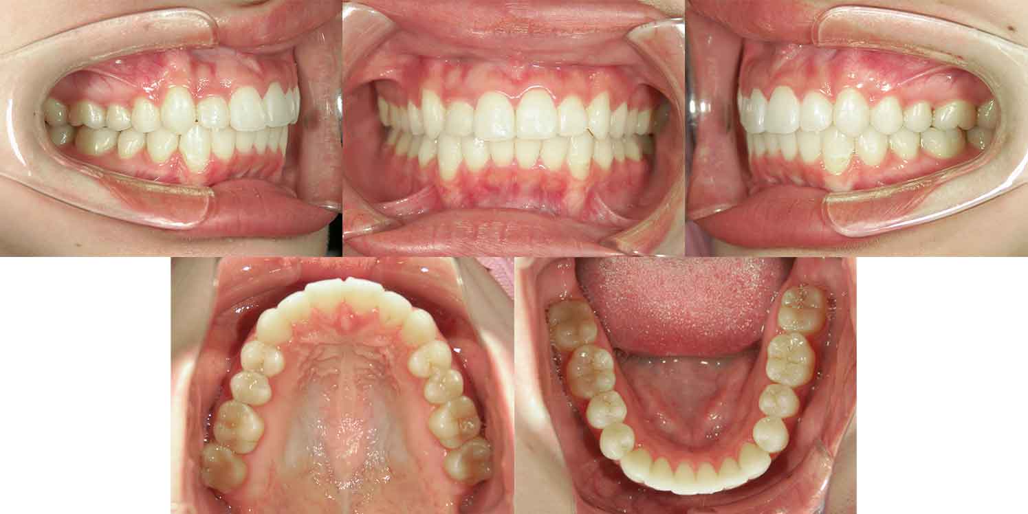 横浜市・20代女性の矯正治療後