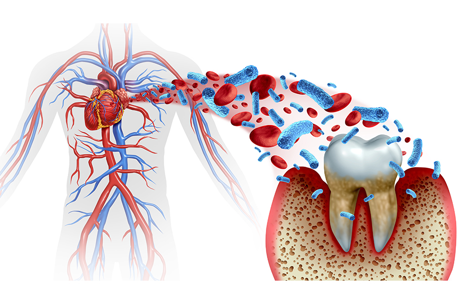 歯周病は進行すると全身に影響する
