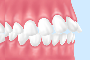 上顎前突（じょうがくぜんとつ）